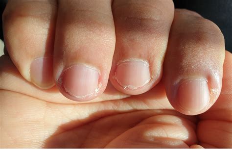 Signs of Vitamin Deficiency in Nails – HealthyCell