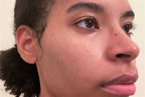 Unbelievable Blackhead Removal 2024: The Dermatologist's Approved Method - sq0ifkc