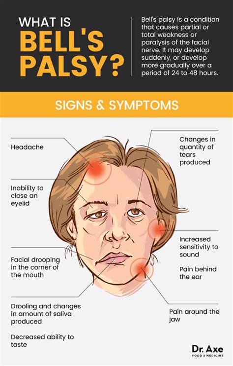 bell bell  palsy  janie davis blog
