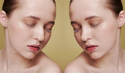 Rhinoplasty Transformations | Before and After Photos