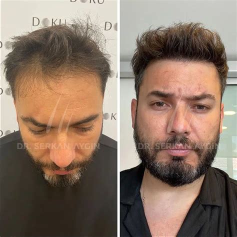 hair transplant istanbul turkey