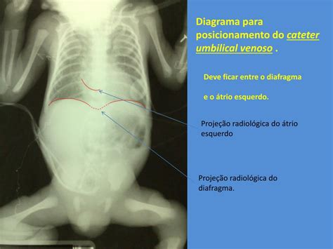 Qual Cateter Fura O Umbigo - PPT - POSICIONAMENTO DE CATETER UMBILICAL PowerPoint Presentation, free ...