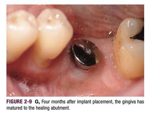 dental implant healing   expect   stage