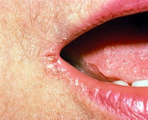 Angular Cheilitis Treatment | Causes | How to get rid of it?