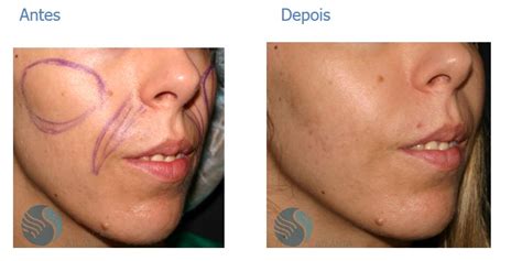 Lipoenxertia No Rosto Antes E Depois - Lipoenxertia Face Fotos Antes E Depois Livros