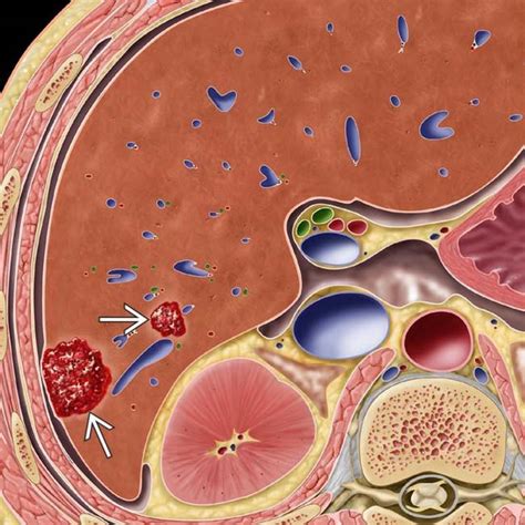 Hepatic Cavernous Hemangioma | Clinical Gate