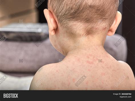 Roseola Rash Viral Image & Photo (Free Trial) | Bigstock