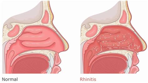 rhinitis
