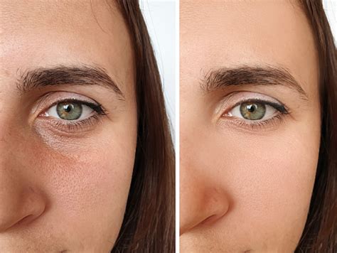 Enrugar Ou Enrrugar - Foto de Mulher Enrugar Antes E Depois Da Colagem Tratamento e mais ...