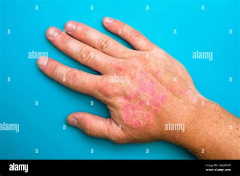 burns  hand wounds hand  sunburn type  burn stock photo alamy