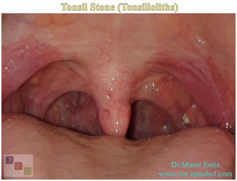 Tonsil Stone - Definition, Symptoms and Treatment