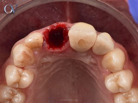 ᐈ Alveolitis Seca - Diagnóstico, tratamiento y prevención ⭐