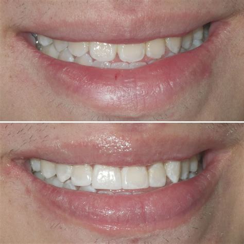Smile Gallery - Before & After Photos | Coolidge Corner Dental