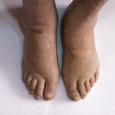 Common Causes of Swollen Feet — Precision Foot and Ankle Centers