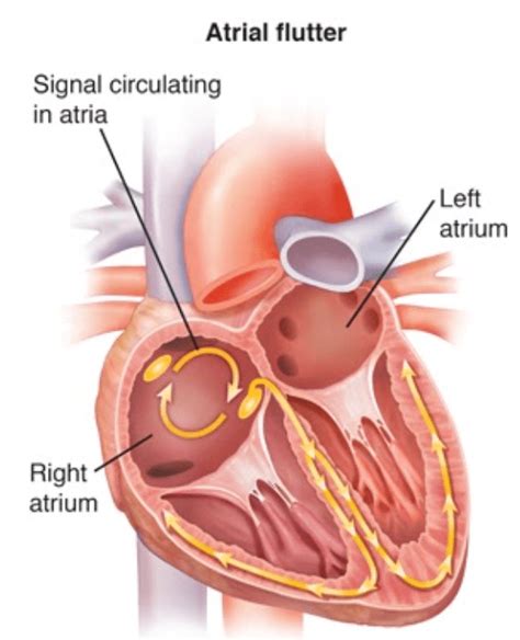 Atrial Flutter Ablation - Rhythm & Cardiac Specialists