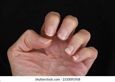 Nail Bed Infection Fungal Abnormality Stock Photo 1533091958 | Shutterstock