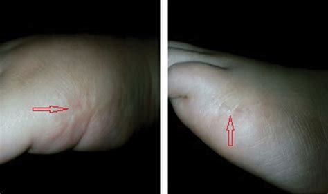 The patient had undergone surgery for correcting the postaxial... | Download Scientific Diagram