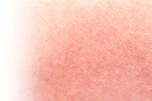 kulit iritasi noroid