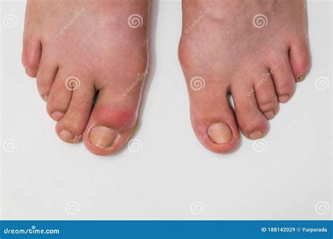 Gout On The Big Toe Appears As Redness And A Unbearable Pain Stock ...