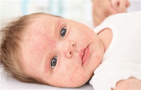 Milk Allergy Skin Rash: Understanding Cow’s Milk Allergy Symptoms and ...