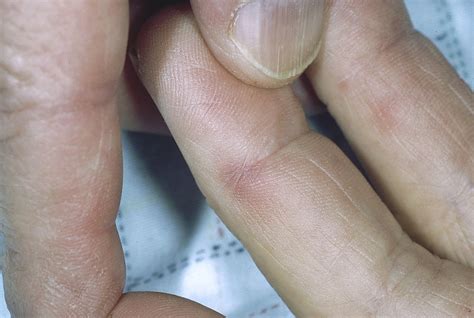 janeway lesions infektiose endokarditis osler knoten und janeway
