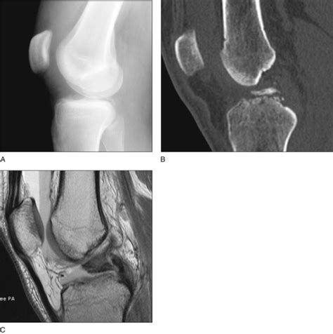34: Tibial Spine Fracture: Arthroscopic and Open Reduction and Internal ...