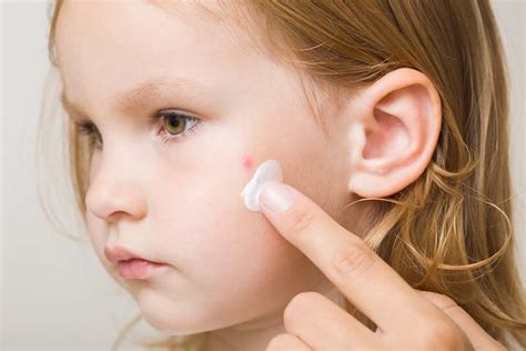 Toddler Acne: Causes, Symptoms And Treatment - Baby Plumbing