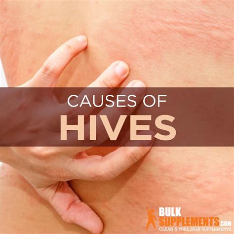 What Causes Itchy Hives On Hands at Samantha Tipping blog