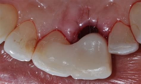 broken tooth marina bay prosthodontics dental emergency