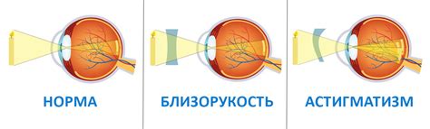 Миопический астигматизм: что это такое, лечение обоих глаз