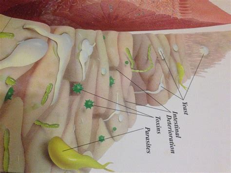 SIBO Small Intestinal Bacterial Overgrowth - The Redwood Clinic