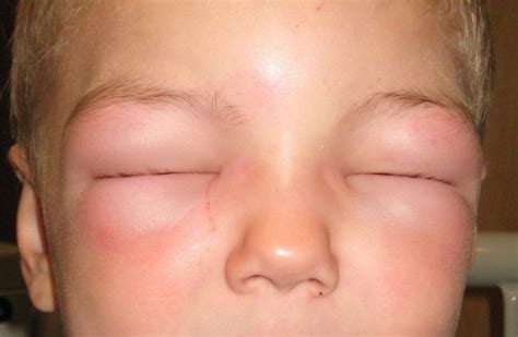 Angioedema - Definition of Angioedema