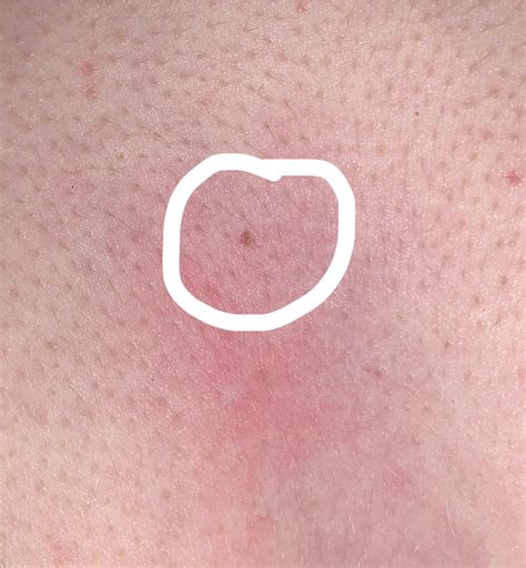 Is it normal to get a few new moles in my early twenties? I noticed