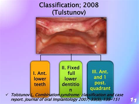 Combination syndrome revisited