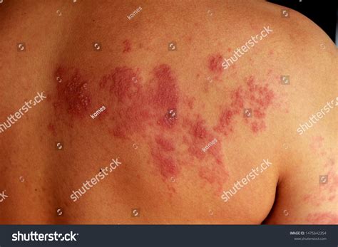 Severe Dermatitis Due Exposure Virus Stock Photo 1475642354 | Shutterstock