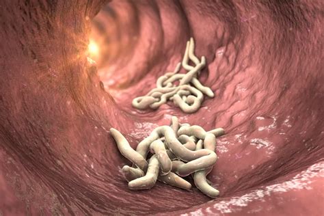 O Que Vermes Podem Causar - Gastroenterologista cita sinais que podem indicar vermes no intestino