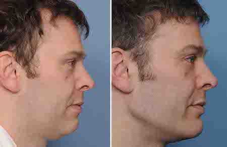 Genioplasty vs Chin implants | Looksmaxxing Forum