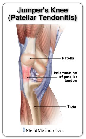 Quad Exercises and Stretches for Patellar Tendonitis