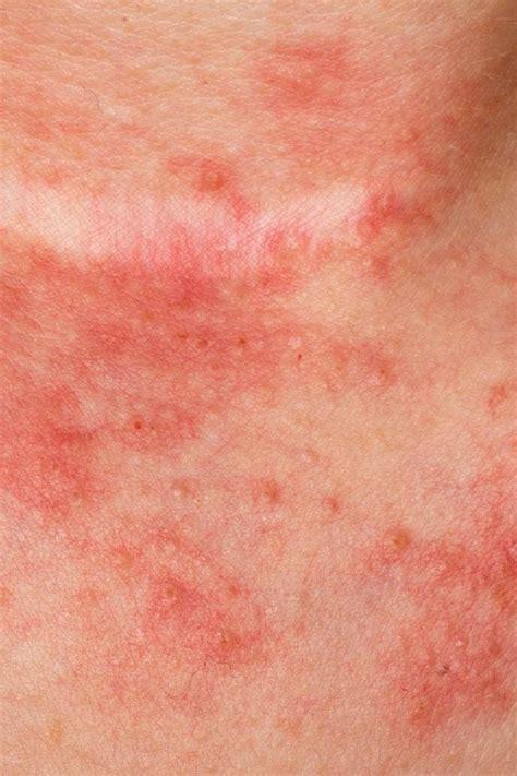 eczema  atopic dermatitis rashes  symptoms