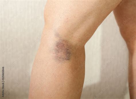 Dark blue, black bruise on the back of the female leg as a result of a ruptured vessel. A vein ...