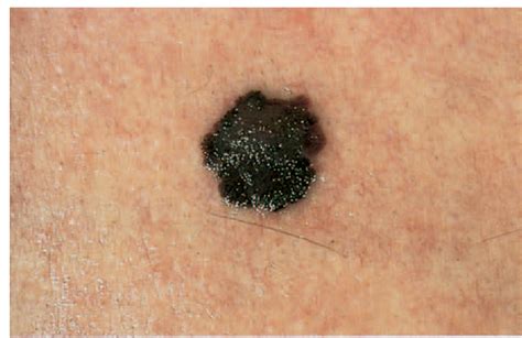 Early Skin Cancer Stages - CancerWalls