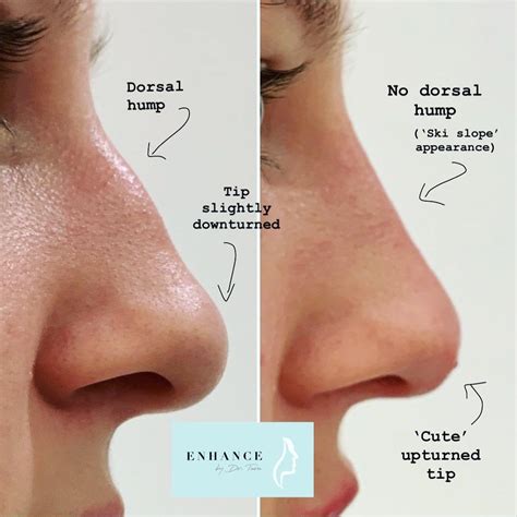 upturned ski slope nose perfect ski slope nose small ski slope nose