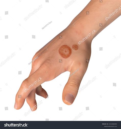 Fungal Infection On Mans Hand Tinea Stock Illustration 2151482093 ...