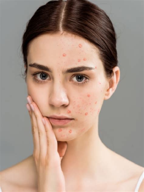 dont pop pimples   natural remedies  healthshots