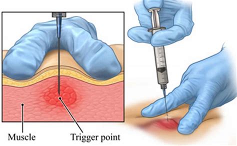 TRIGGER POINT INJECTIONS: Kanuru Interventional Spine and Pain ...