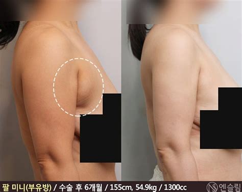 副乳とはどこの部位？？副乳について見てみよう！！ | Nスリム医院【韓国公式엔슬림의원】