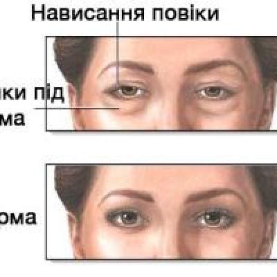 Пластика повік