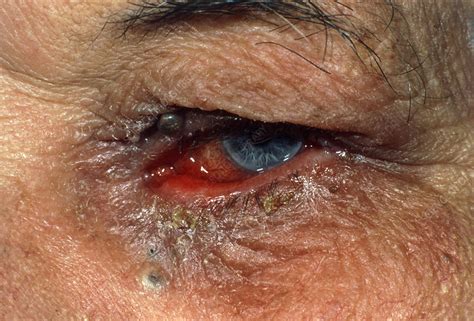 how to know you have a stye