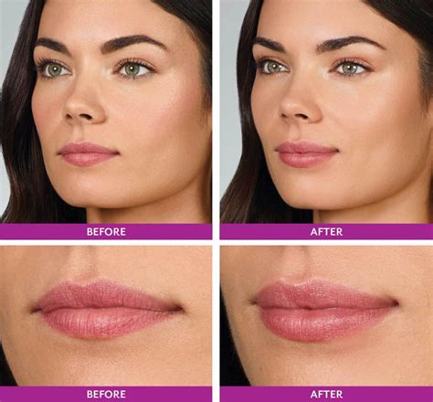 Juvederm Volbella dermal filler lip enhancement before and after photos ...