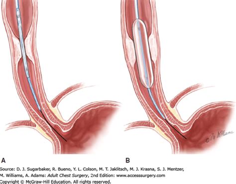 Techniques for Dilation of Benign Esophageal Stricture | Thoracic Key